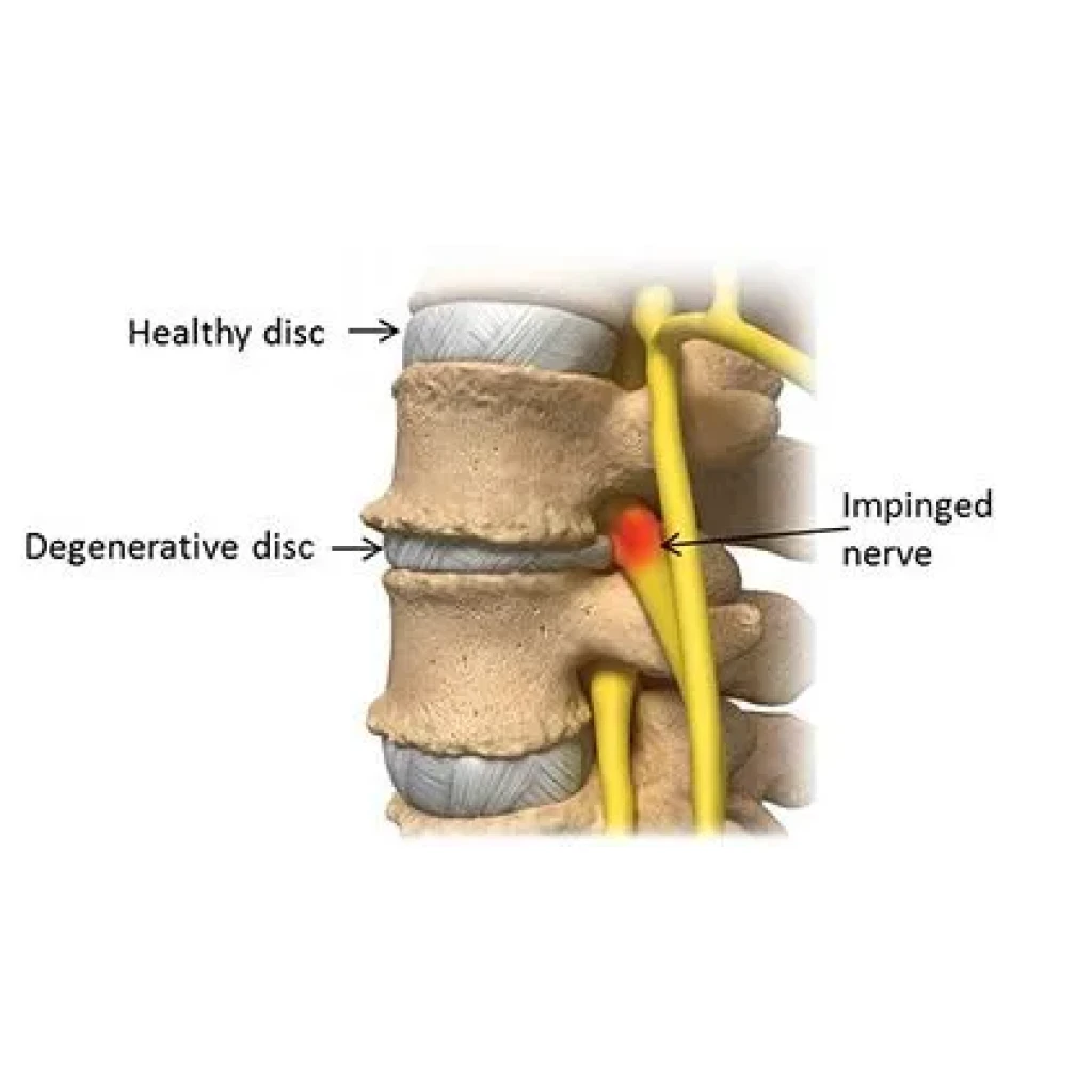 Degenerative Disk Treatments