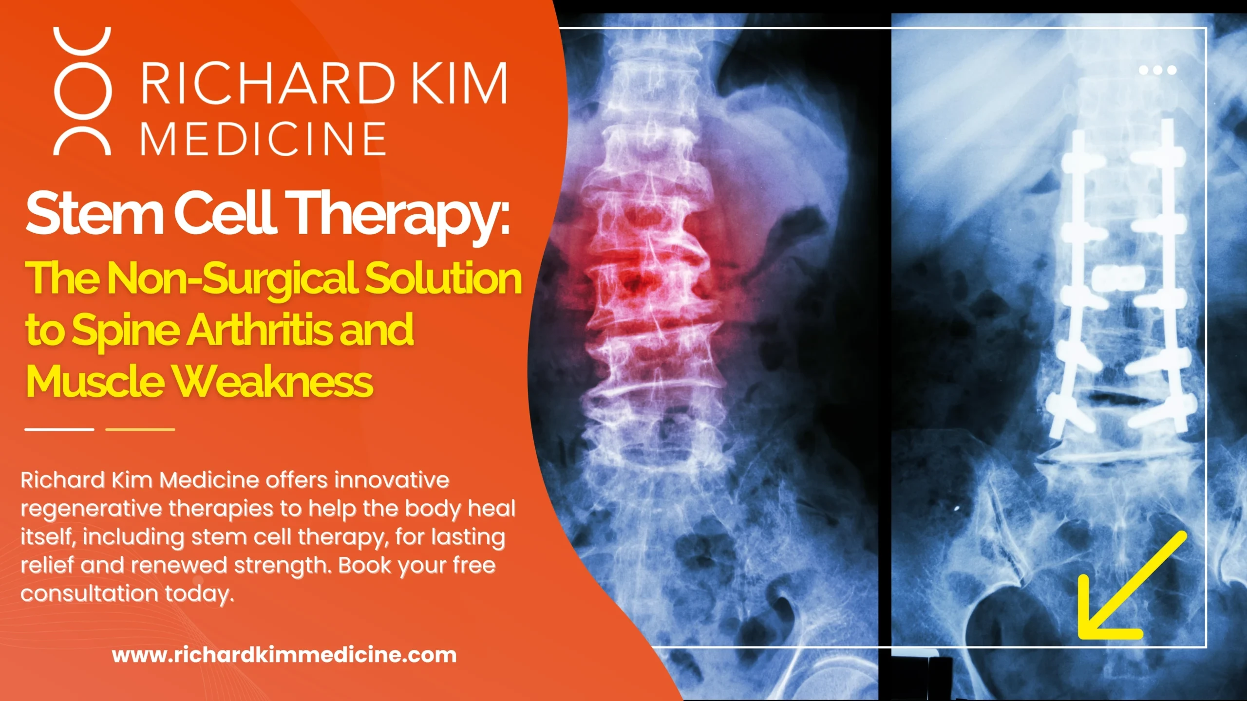 Stem Cell Therapy: The Non-Surgical Solution to Spine Arthritis and Muscle Weakness