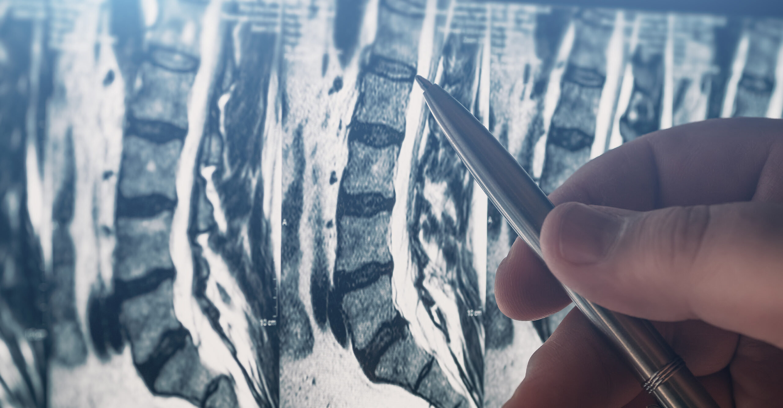 How Does Stem Cell Therapy Work for Back Pain?